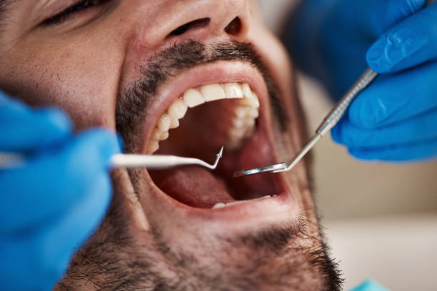 Best Emergency Tooth Extraction in New Brighton, MN